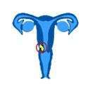 সার্ভিক্যাল ক্যান্সার